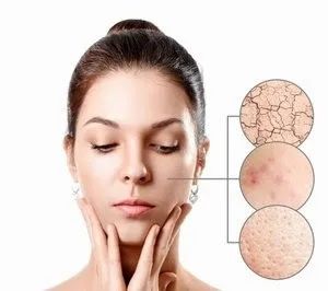 什么是春敏？如何預(yù)防春敏？