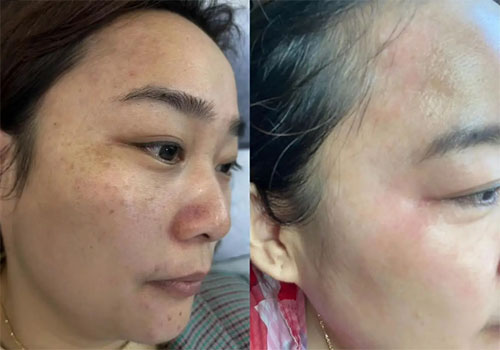 祛斑最好的土方法有哪些？