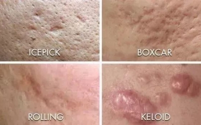 如何祛除痘坑？祛除痘坑最好的方法