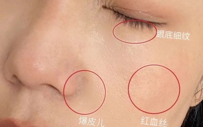 如何判斷自己是不是干敏肌膚？干敏肌有哪些特征？