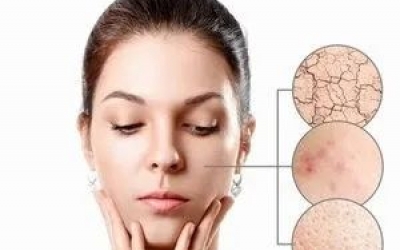 什么是春敏？如何預(yù)防春敏？