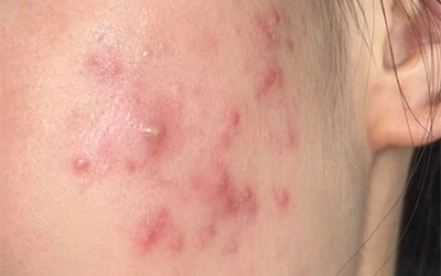 油痘肌和油敏肌怎么區(qū)分？油痘肌和油敏肌的區(qū)別！